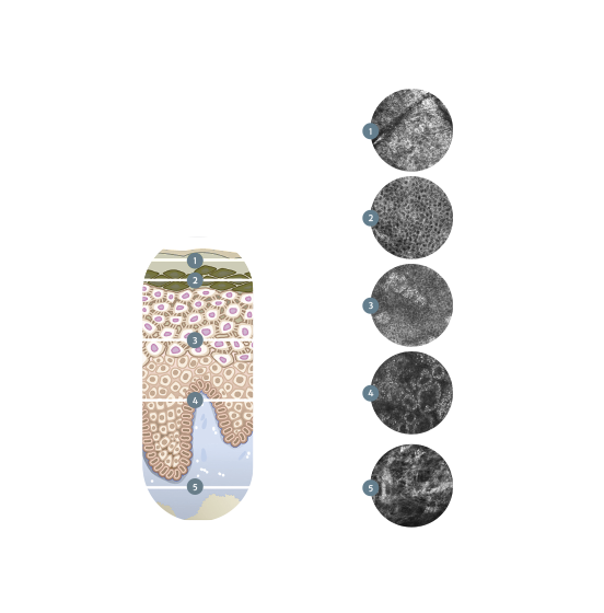 Examining with the VivaScope technology (confocal microscopy)