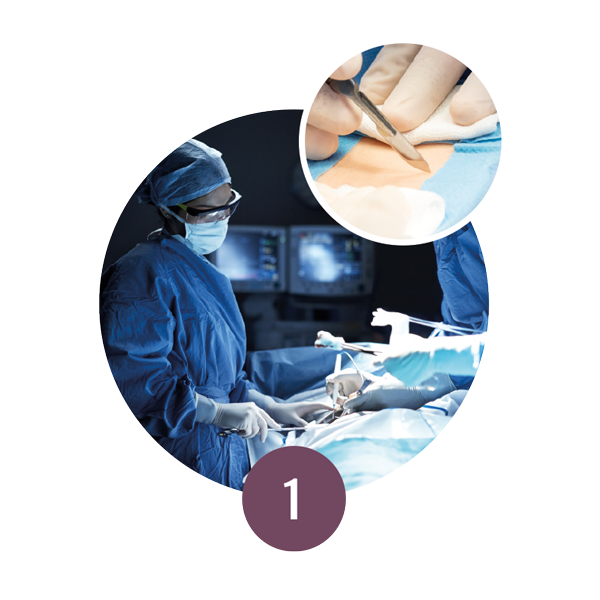 Standard tissue removal